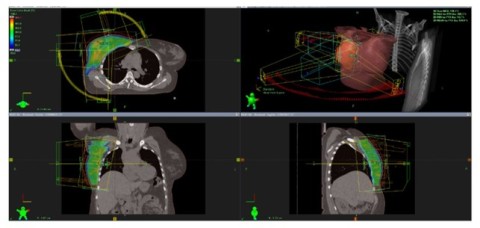 Oikean rinnan sädehoitosuunnitelma